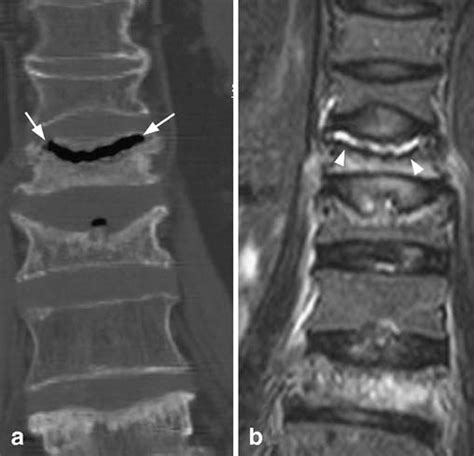 Intravertebral vacuum phenomenon. This 80-year-old woman presented with ...