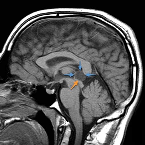 Pineal Gland Mri