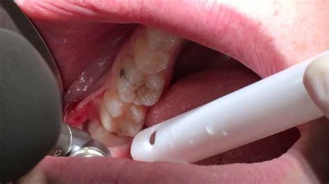 Rotten Tooth Extraction Houston TX 77084 - KeemSmile