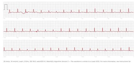 inappropriate sinus tachycardia, does this look like anything else? : r ...