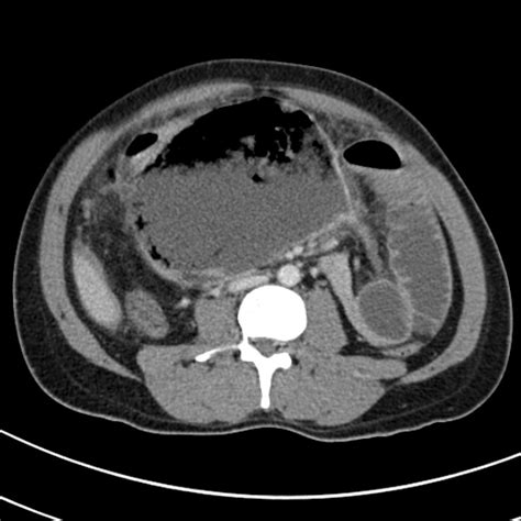 Gastrointestinal perforation CT - wikidoc