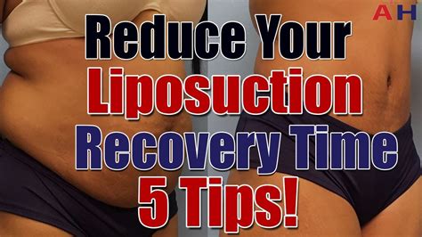 Liposuction Recovery Care - Reduce Your Liposuction Surgery Recovery Time - 5 Tips! - YouTube