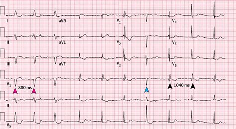 Abnormal Electrocardiogram in a Woman With Atrial Fibrillation and Recent Care Transition ...