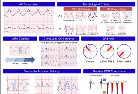 Ventricular Tachycardia Ecg