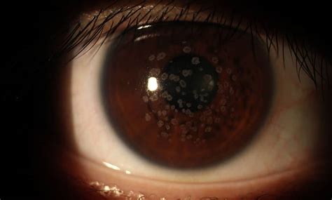 Clinical photography - Corneal granular dystrophy | Spectrum