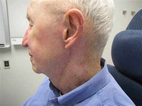 Closed Suction (Jackson Pratt) Drain Placement and Removal | Iowa Head and Neck Protocols