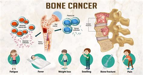 Bone Cancer- Symptoms, causes, and treatment. :: Health Reactive Body ...