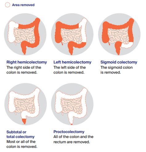 Treatment for early bowel cancer - Cancer Council Victoria