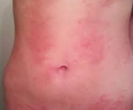 What Causes Itchy Rash All Over Body? | New Health Advisor