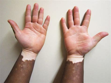 Vitiligo: Illustrated guide to pigmentation disorder