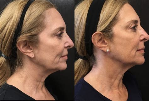 The New Neck Lift: We Tried Botox In Our Neck - In The Groove