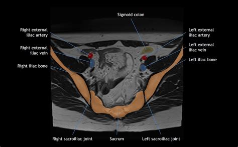 Hip Bone Anatomy Ct Scan