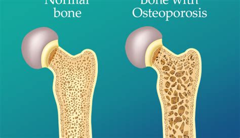 Osteoporosis: Causes, Symptoms and Treatment - Public Health Notes