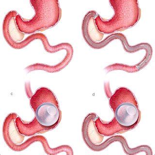 Device placement in (a) baseline group, (b) duodenal-jejunal bypass... | Download Scientific Diagram