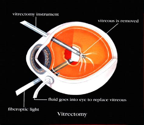 Macula Hole » Eye Care Specialists, Optometrists at Noel Templeton ...