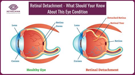 Retinal Detachment - What Should Your Know About This Eye Condition