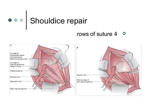 Types of Repair - Sports Hernia Specialist