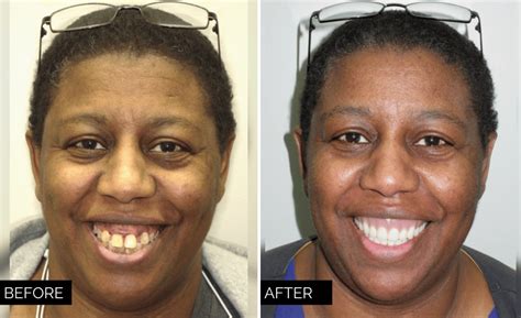 Dentures Before and After Photos - Wilkinson Dental