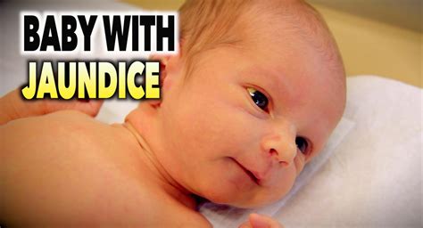 Jaundice In Newborns - Causes, Signs, Symptoms, Diagnosis & Treatment