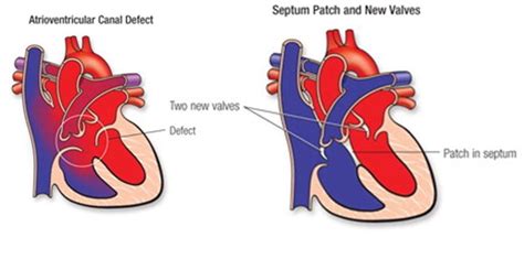 Atrioventricular Canal Defect