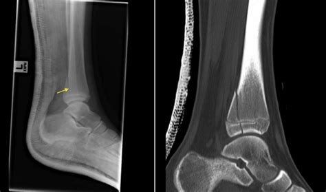 Salter-Harris IV Fracture - radiograph and CT - Radiology at St. Vincent's University Hospital