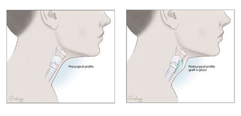 Adam’s Apple Surgery – Augmentation via Natural Implant for FTM Facial ...