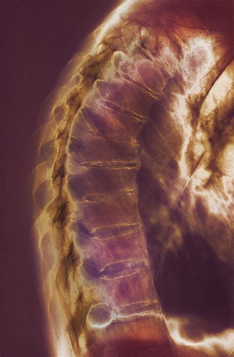 Ankylosing Spondylitis X-ray Photograph by Cnri