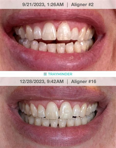 Open bite progress : r/Invisalign