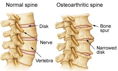 Degenerative Joint Disease & Osteoarthritis - Harmony Chiropractic Clinic