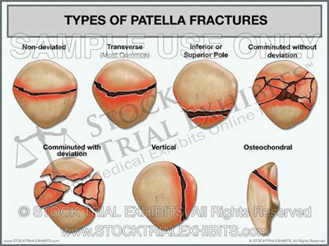 Types of Patella Fractures Trial Exhibit – Stock Trial Exhibits