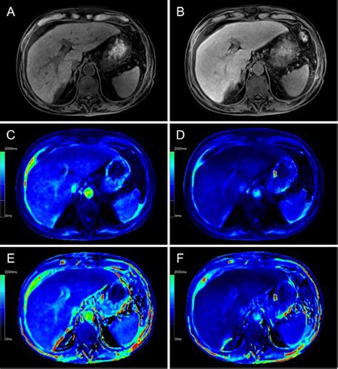 Evaluation of two-point Dixon water-fat separation for liver specific contrast-enhanced ...