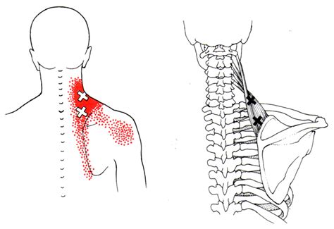 Levator Scapulae | The Trigger Point & Referred Pain Guide