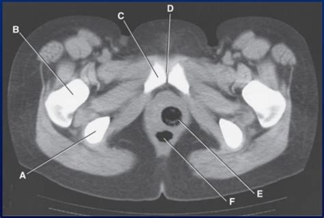 CT Anatomy - Symphysis pubis Diagram | Quizlet