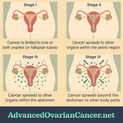 What Are The Stages Of Ovarian Cancer?