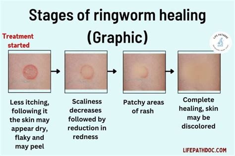 The Healing Stages of Ringworm (with Pictures)