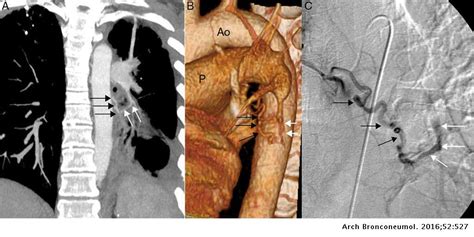 Embolization of Acquired Bronchial Artery-Pulmonary Artery Fistula in a ...