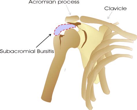 Subdeltoid Bursitis Shoulder