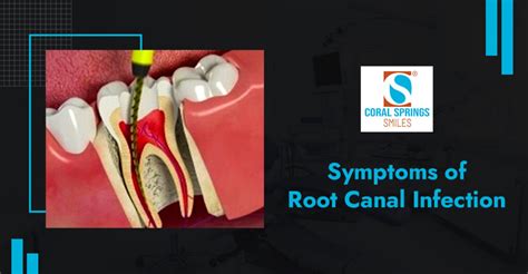 Symptoms of Root Canal Infection