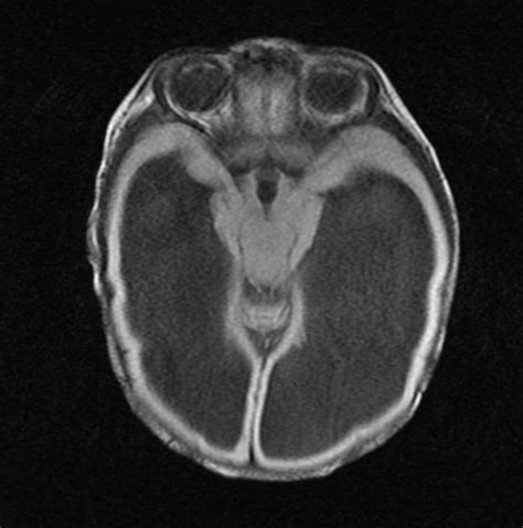 Hydrocephalus MRI - wikidoc