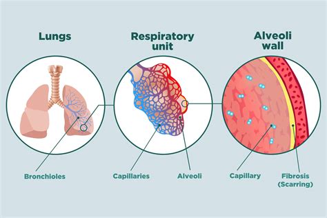 Facts About Pulmonary Fibrosis