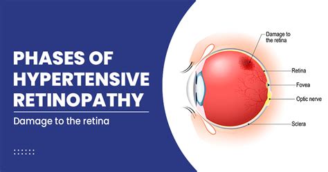 Hypertensive Retinopathy