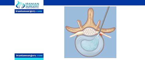 herniated disc surgery recovery time | herniated disc surgery cost