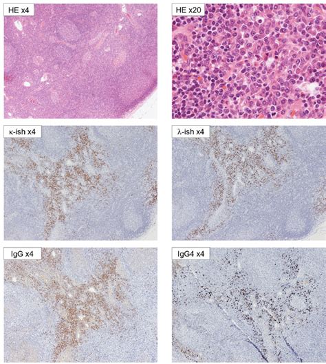 Biopsy of an inguinal lymph node in the right side. The plasma cells... | Download Scientific ...