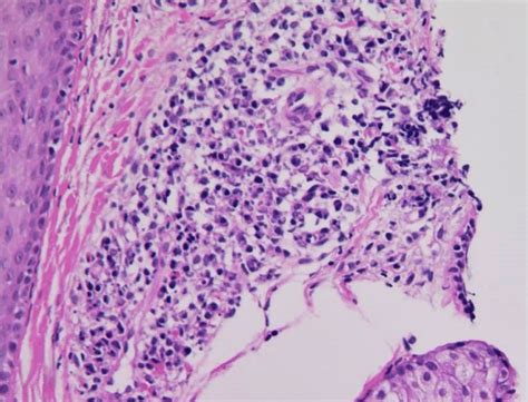 (A) Spongiosis in the epidermis with exocytosis of eosinophils and... | Download Scientific Diagram