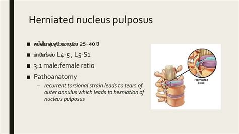 Herniated nucleus pulposus