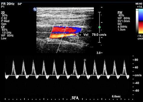 Normal Doppler Spectral Waveforms of Major Pediatric Vessels: Specific Patterns | RadioGraphics