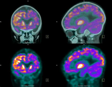 Melanoma Brain Metastases: ‘Absolutely Treatable in 2021’ - Cancer Therapy Advisor