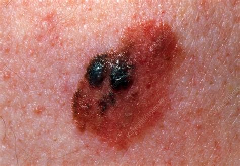 Close-up of a malignant melanoma on an elderly man - Stock Image - M131 ...