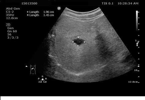 US image of a liver cyst. | Download Scientific Diagram