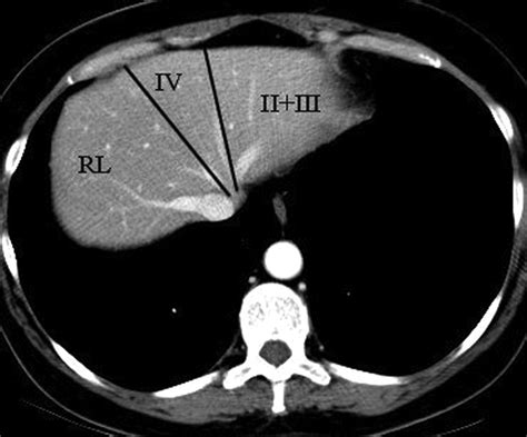 Liver Segmental Anatomy Ct Scan